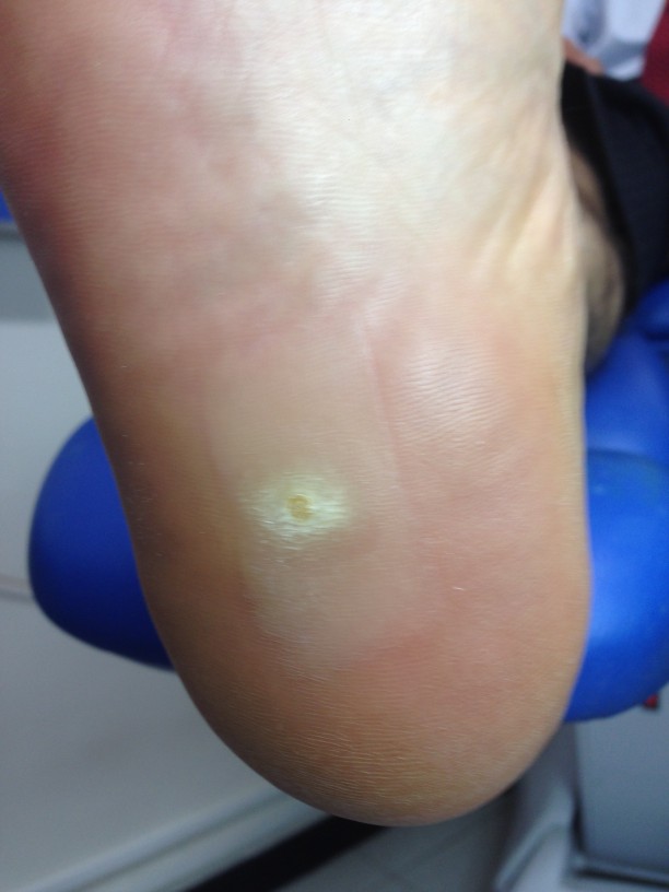 papiloma plantar, ojo de pescado