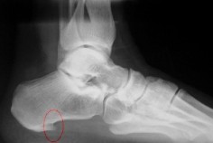 espolon calcaneo podologo pogota Dr Angee manejo de fascitis con ondas de choque